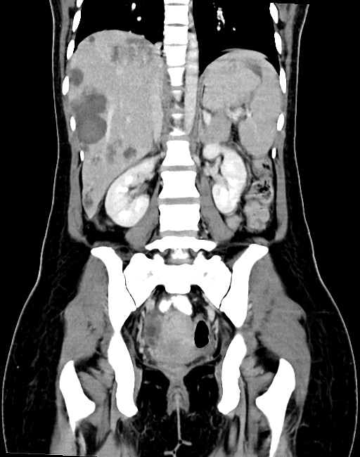Choriocarcinoma liver metastases (Radiopaedia 74768-85766 B 65).jpg