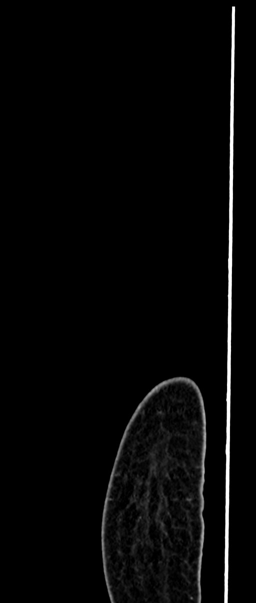Choriocarcinoma liver metastases (Radiopaedia 74768-85766 C 17).jpg