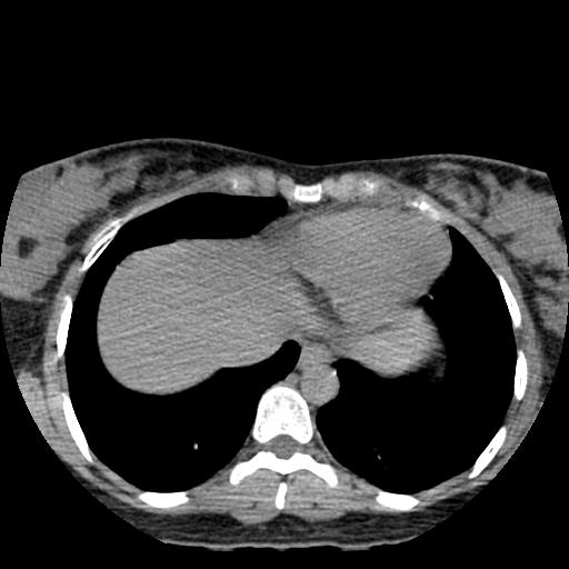 Choriocarcinoma of ovary with cerebral and pulmonary metastases (Radiopaedia 25983-26119 Axial non-contrast 24).jpg