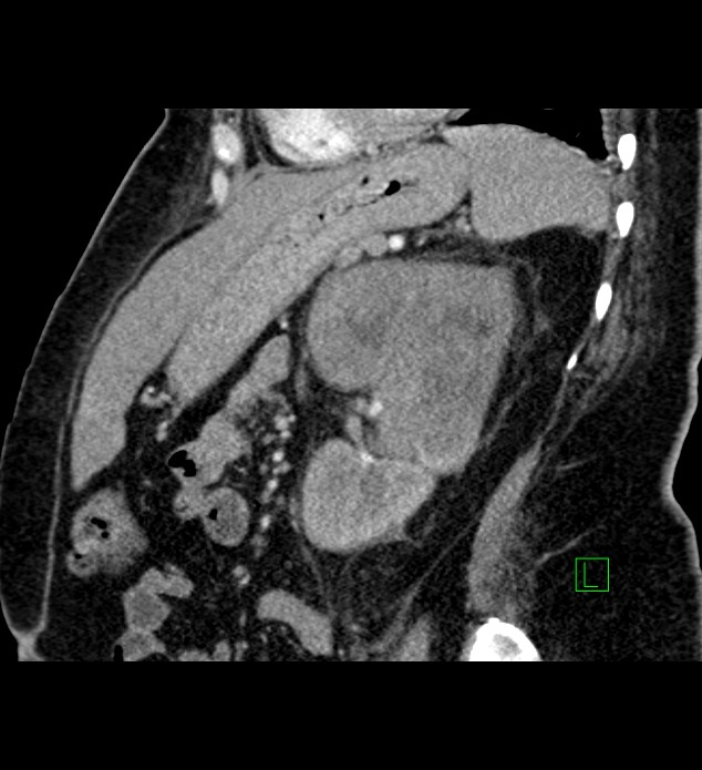 Chromophobe renal cell carcinoma (Radiopaedia 84239-99519 D 42).jpg