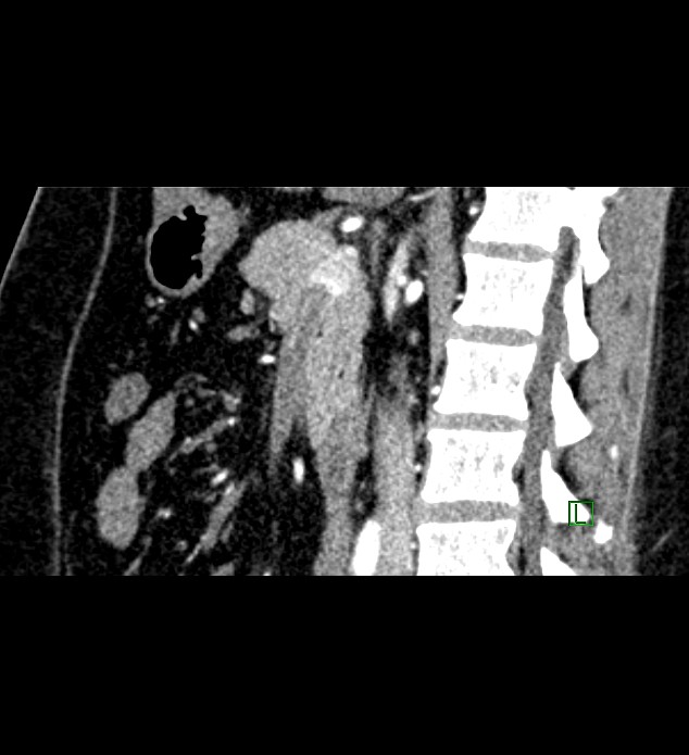 Chromophobe renal cell carcinoma (Radiopaedia 84286-99573 F 88).jpg