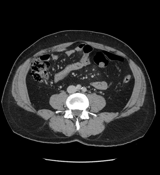 Chromophobe renal cell carcinoma (Radiopaedia 86879-103083 C 87).jpg