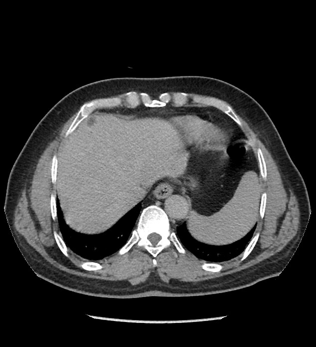 Chromophobe renal cell carcinoma (Radiopaedia 86879-103083 D 13).jpg
