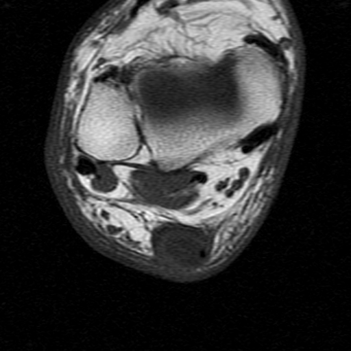File:Chronic Achilles tendon rupture (Radiopaedia 15262-15100 Axial T1 12).jpg