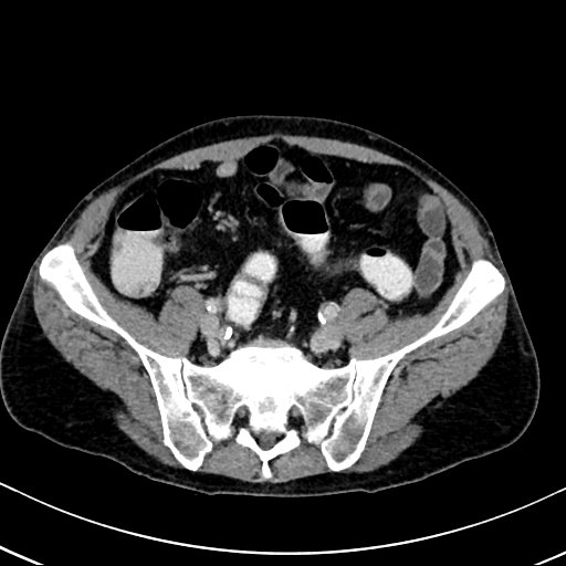 Chronic appendicitis complicated by appendicular abscess, pylephlebitis and liver abscess (Radiopaedia 54483-60700 B 110).jpg