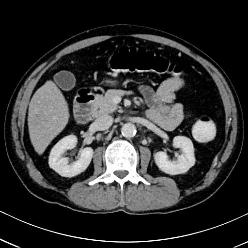 Chronic appendicitis complicated by appendicular abscess, pylephlebitis and liver abscess (Radiopaedia 54483-60700 B 64).jpg