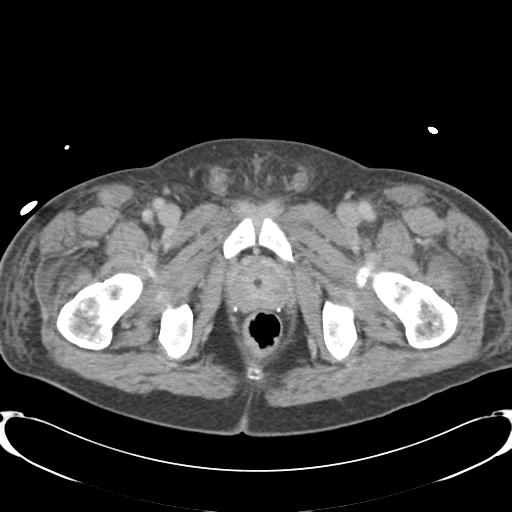 Chronic diverticulitis complicated by hepatic abscess and portal vein thrombosis (Radiopaedia 30301-30938 A 93).jpg