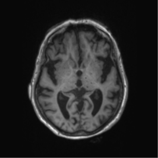 File:Chronic hypertensive encephalopathy (Radiopaedia 72844-83495 Axial T1 39).png