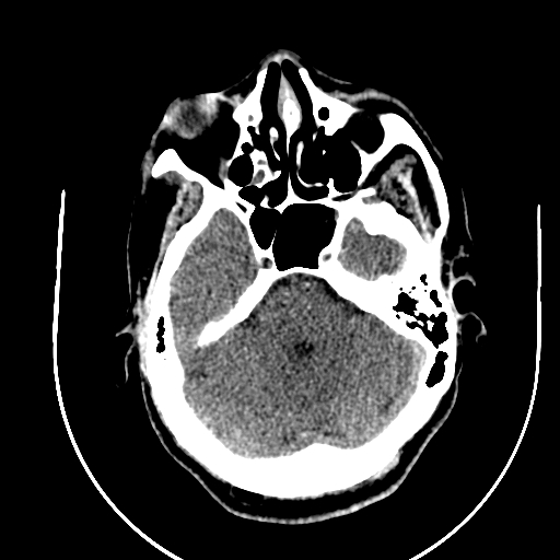 Chronic invasive fungal sinusitis (Radiopaedia 91563-109286 Axial non-contrast 25).jpg