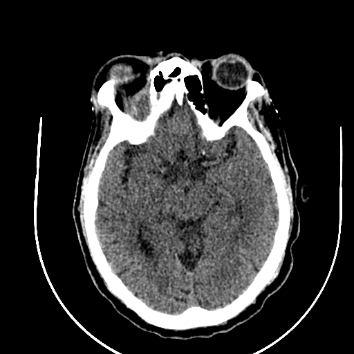 Chronic invasive fungal sinusitis (Radiopaedia 91563-109286 Axial non-contrast 46).jpg