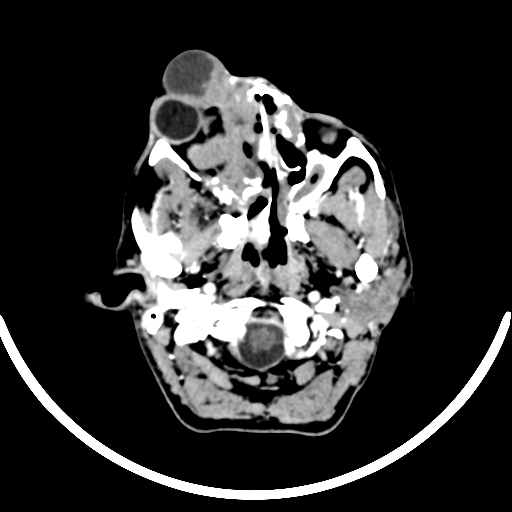 Chronic invasive fungal sinusitis with intraorbital and intracranial extension (Radiopaedia 56387-63046 B 65).jpg
