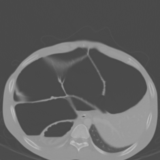 Chronic large bowel pseudo-obstruction (Radiopaedia 43181-46492 Axial bone window 44).jpg