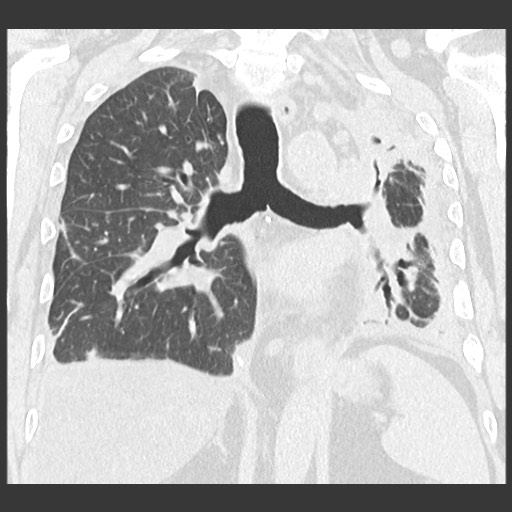 File:Chronic lung allograft dysfunction - restrictive form (Radiopaedia 60595-68316 Coronal lung window 63).jpg