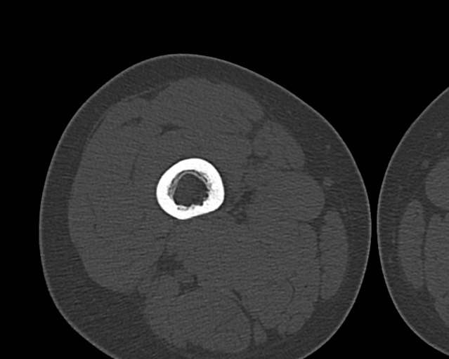Chronic ostemyelitis of the femur with long sinus tract (Radiopaedia 74947-85982 Axial bone window 72).jpg