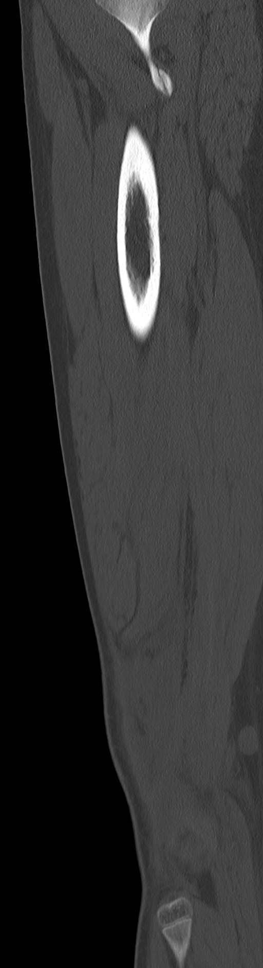 Chronic ostemyelitis of the femur with long sinus tract (Radiopaedia 74947-85982 Sagittal bone window 35).jpg