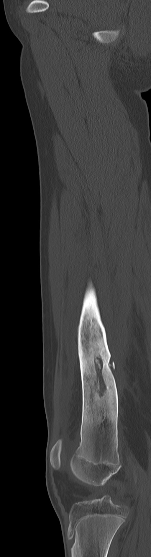 Chronic ostemyelitis of the femur with long sinus tract (Radiopaedia 74947-85982 Sagittal bone window 56).jpg