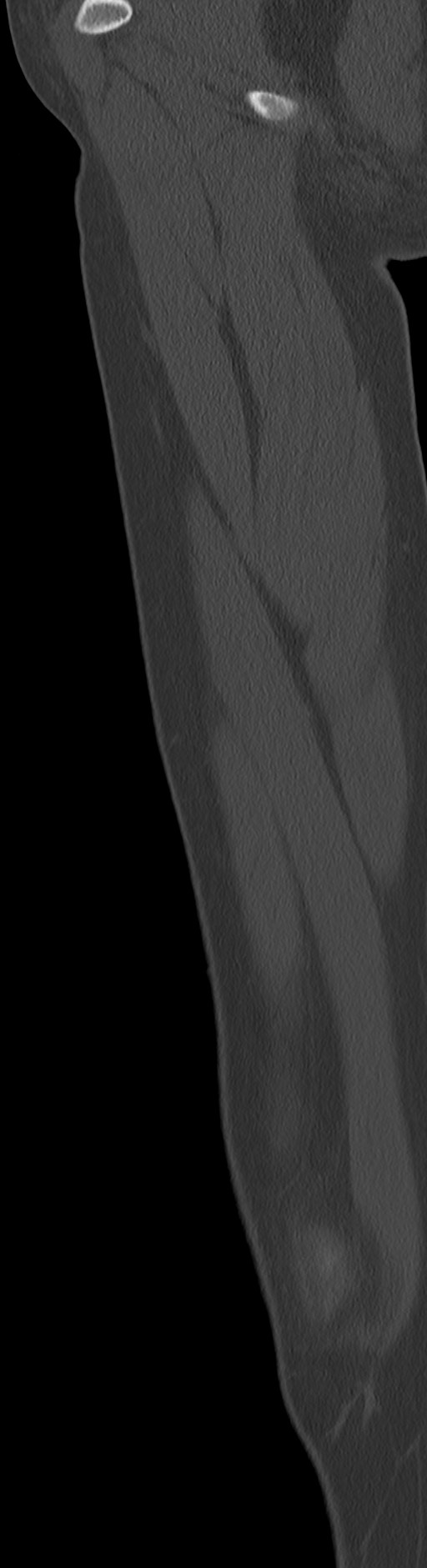 Chronic ostemyelitis of the femur with long sinus tract (Radiopaedia 74947-85982 Sagittal bone window 86).jpg
