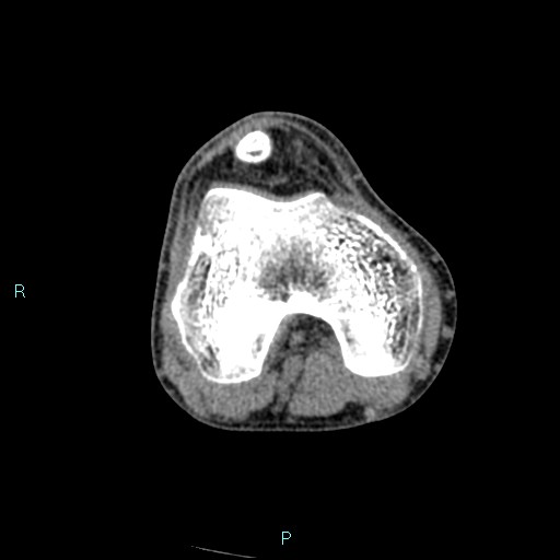 Chronic osteomyelitis (with Brodie abscess) (Radiopaedia 76405-88111 A 132).jpg
