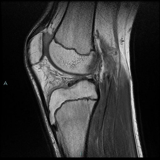 File:Chronic osteomyelitis (with Brodie abscess) (Radiopaedia 76405-88112 Sagittal PD 16).jpg
