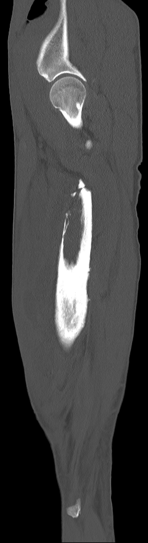Chronic osteomyelitis (with sequestrum) (Radiopaedia 74813-85822 C 88).jpg
