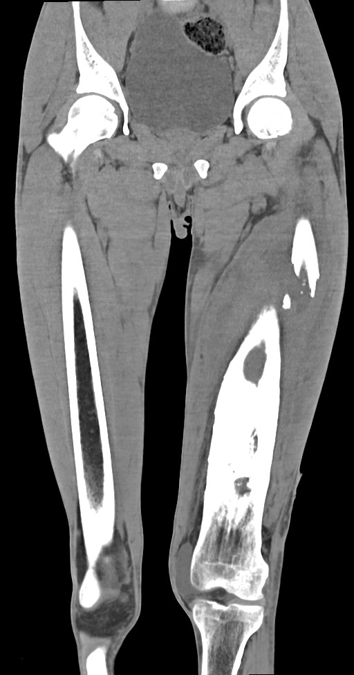 Chronic osteomyelitis (with sequestrum) (Radiopaedia 74813-85822 E 23).jpg