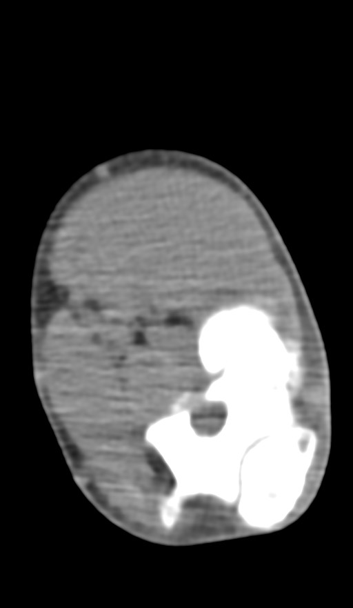 Chronic osteomyelitis of the distal humerus (Radiopaedia 78351-90971 Axial non-contrast 97).jpg