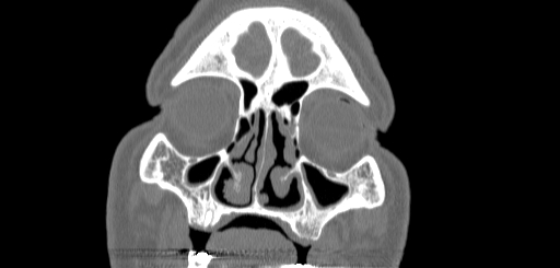 Chronic sphenoidal sinusitis (Radiopaedia 62030-70122 Coronal bone window 31).jpg