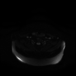 Chronic submandibular sialadenitis (Radiopaedia 61852-69885 Axial DWI 22).jpg