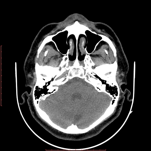 File:Chronic submandibular sialolithiasis (Radiopaedia 69817-79814 Axial non-contrast 4).jpg