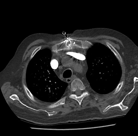 Chronic thromboembolic pulmonary disease (Radiopaedia 90694-108119 Axial C+ CTPA 23).jpg