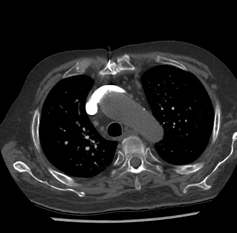 Chronic thromboembolic pulmonary disease (Radiopaedia 90694-108119 Axial C+ CTPA 28).jpg