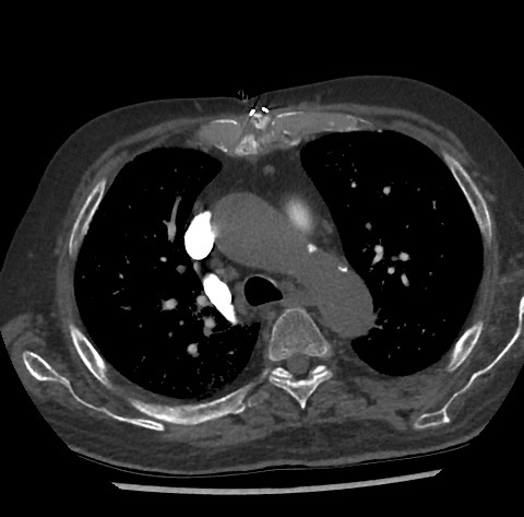 Chronic thromboembolic pulmonary disease (Radiopaedia 90694-108119 Axial C+ CTPA 33).jpg