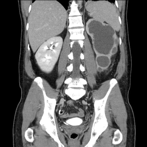 Chronic ureteropelvic junction obstruction (Radiopaedia 78365-90996 B 68).jpg
