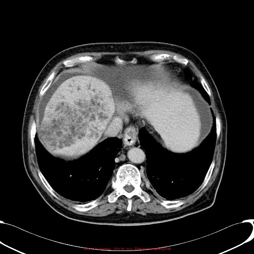 Cirrhosis and hepatocellular carcinoma in the setting of hemochromatosis (Radiopaedia 75394-86595 B 18).jpg