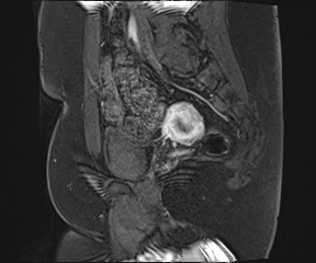 File:Class II Mullerian duct anomaly- unicornuate uterus with rudimentary horn and non-communicating cavity (Radiopaedia 39441-41755 G 79).jpg