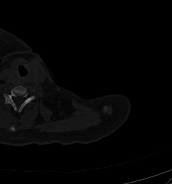 Clear cell chondrosarcoma - humerus (Radiopaedia 63104-71612 Axial bone window 3).jpg