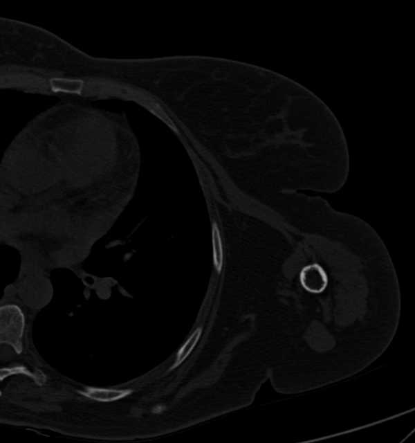 Clear cell chondrosarcoma - humerus (Radiopaedia 63104-71612 Axial bone window 88).jpg