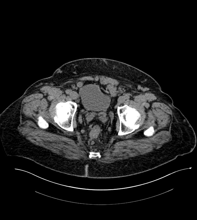 Closed-loop small bowel obstruction-internal hernia (Radiopaedia 78439-91096 Axial non-contrast 143).jpg