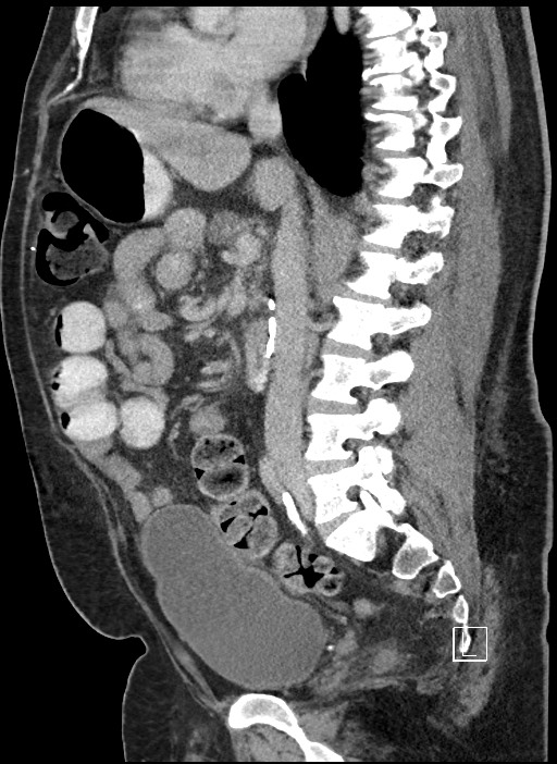 Closed loop obstruction - internal hernia into nephrectomy bed (Radiopaedia 59867-67320 C 51).jpg