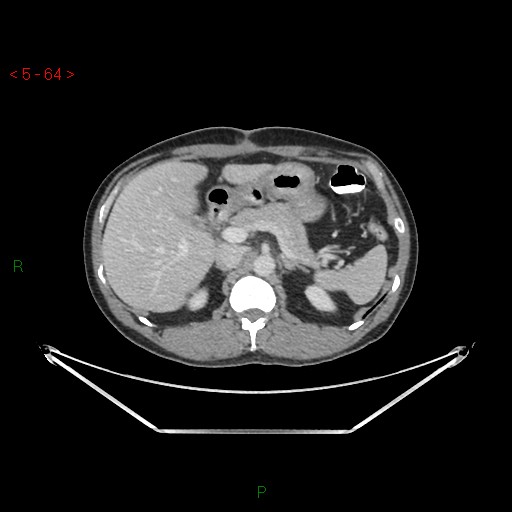 File:Closed loop obstruction and appendicular stump mucocele (Radiopaedia 54014-61158 A 22).jpg