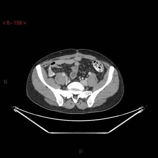 File:Closed loop obstruction and appendicular stump mucocele (Radiopaedia 54014-61158 A 59).jpg