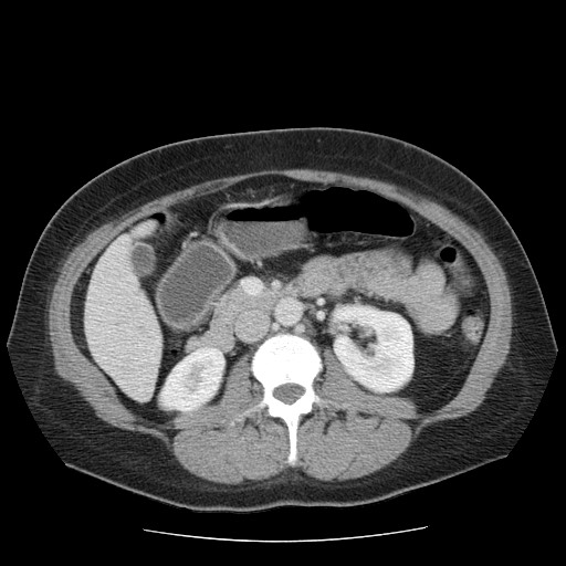 File:Closed loop small bowel obstruction (Radiopaedia 65403-74451 Axial 25).jpg