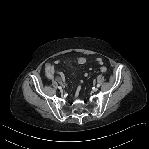 Closed loop small bowel obstruction - adhesions (Radiopaedia 59269-66611 A 100).jpg