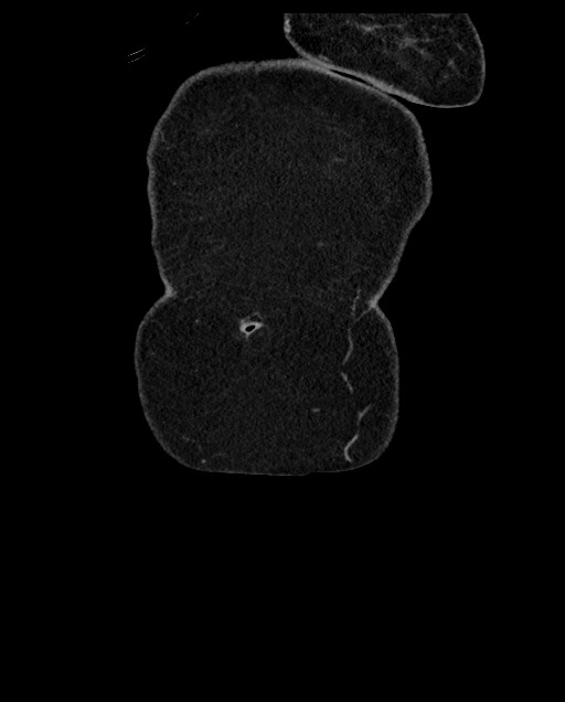 Closed loop small bowel obstruction - adhesions (Radiopaedia 59269-66611 B 8).jpg
