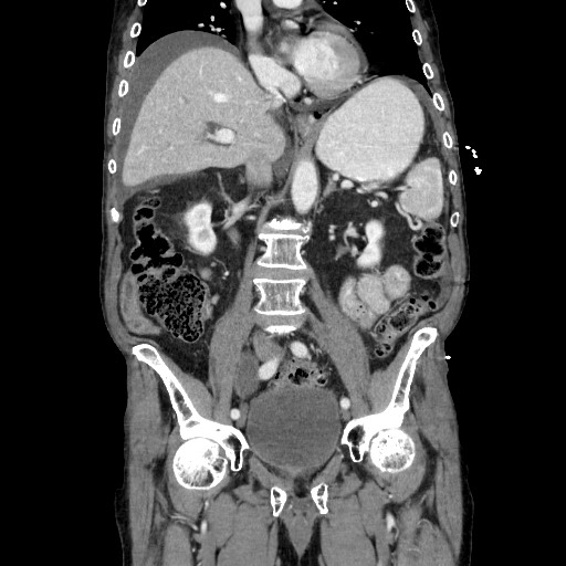 Closed loop small bowel obstruction - adhesive disease and hemorrhagic ischemia (Radiopaedia 86831-102990 B 68).jpg