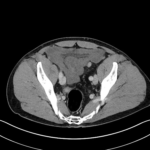 Closed loop small bowel obstruction - internal hernia (Radiopaedia 57806-64778 B 105).jpg