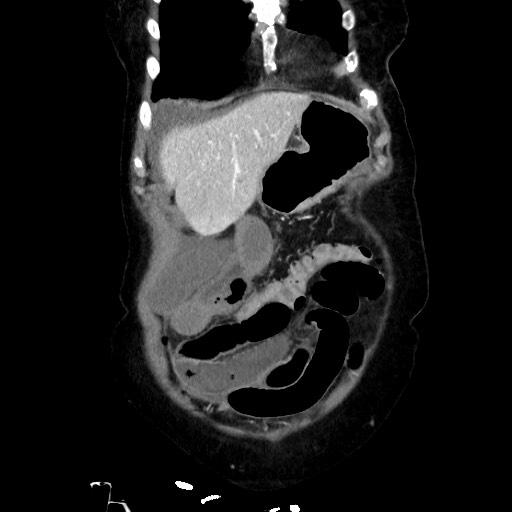 Closed loop small bowel obstruction due to adhesive band, with intramural hemorrhage and ischemia (Radiopaedia 83831-99017 C 29).jpg