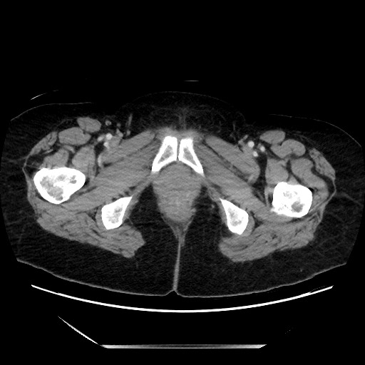 File:Closed loop small bowel obstruction due to adhesive bands - early and late images (Radiopaedia 83830-99014 A 165).jpg