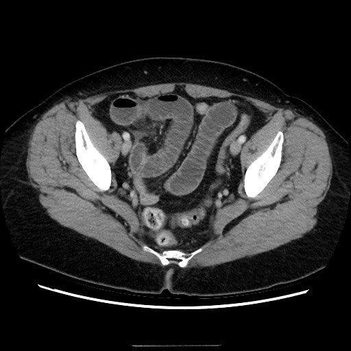 Closed loop small bowel obstruction due to adhesive bands - early and late images (Radiopaedia 83830-99015 A 142).jpg