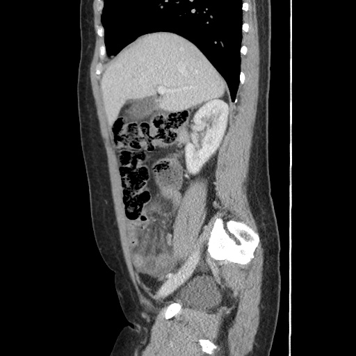 File:Closed loop small bowel obstruction due to trans-omental herniation (Radiopaedia 35593-37109 C 23).jpg